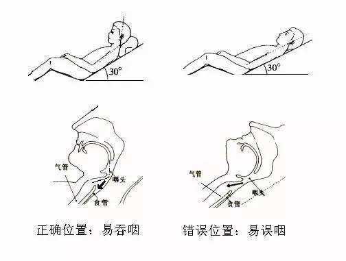 图为吞咽障碍患者姿势指导图
